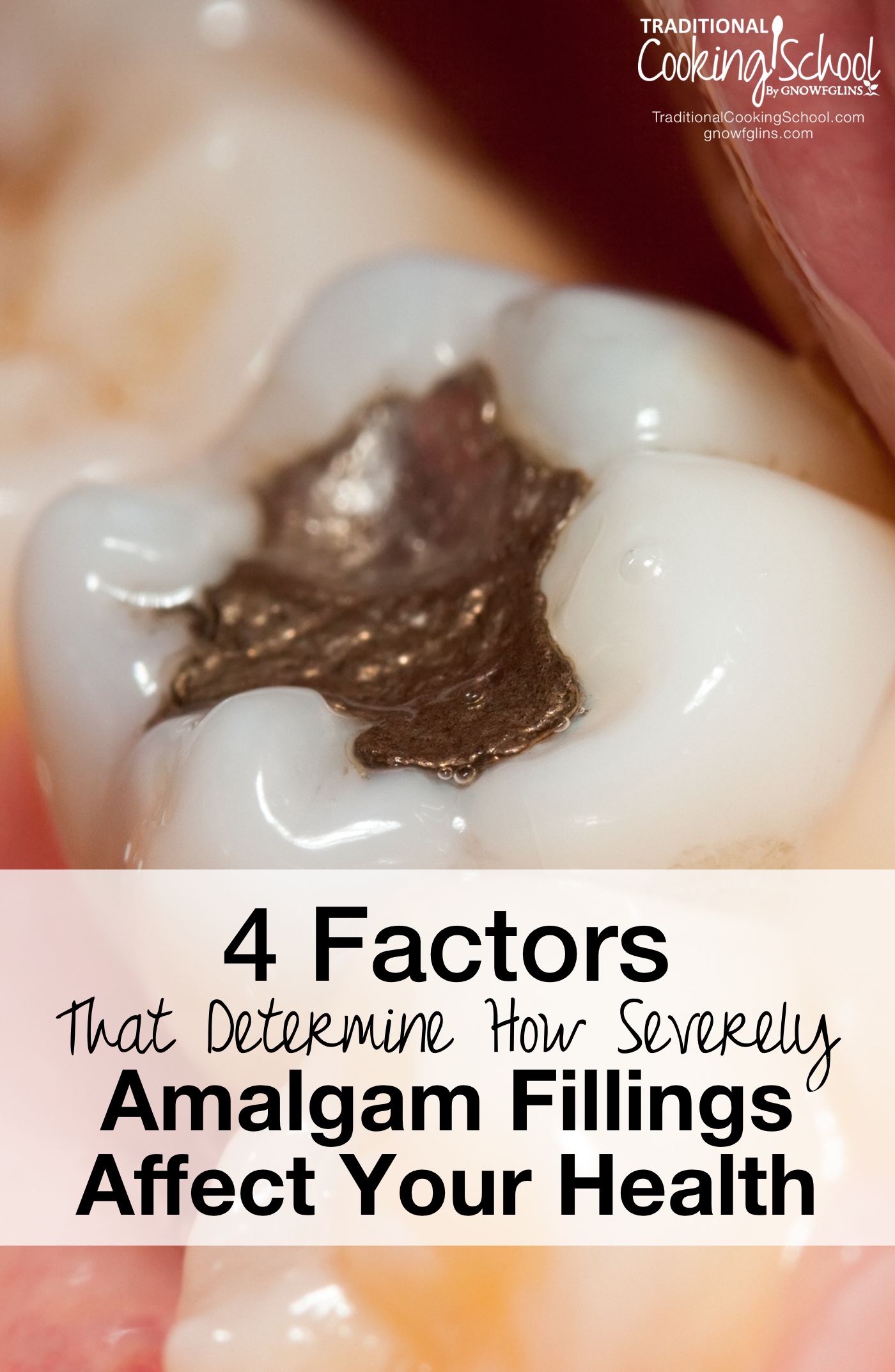 have 99 factors does That Factors Affect Determine Fillings Amalgam 4 How Health