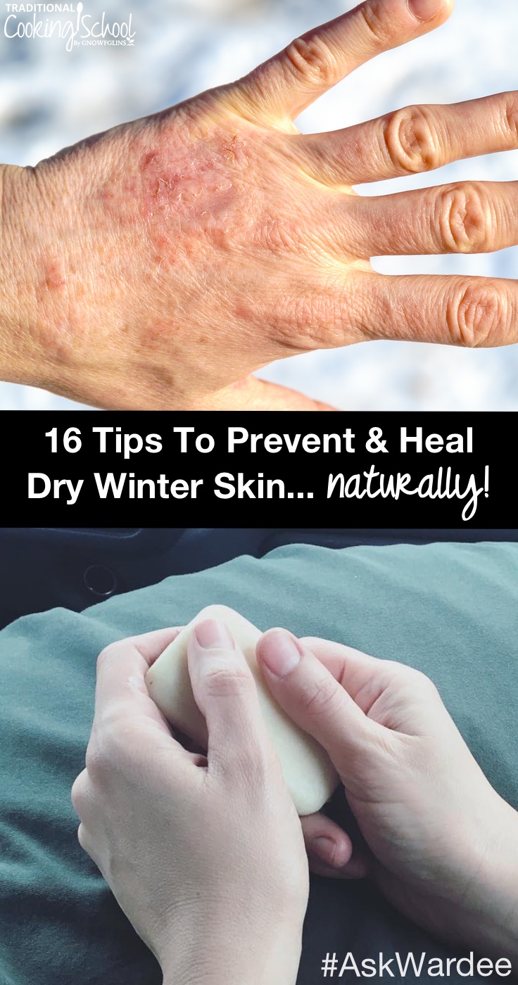 16 Tips To Prevent And Heal Dry Winter Skin Naturally 