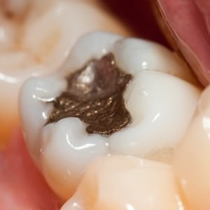 Does long-term, chronic exposure to low doses of mercury vapor pose any risks? What might the health effects be? And, are there any subsets of our population who might have greater sensitivity to mercury? These are the questions we will answer in this continuation of our discussion on mercury amalgam fillings.