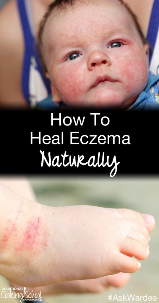 How To Heal Eczema Naturally | #AskWardee