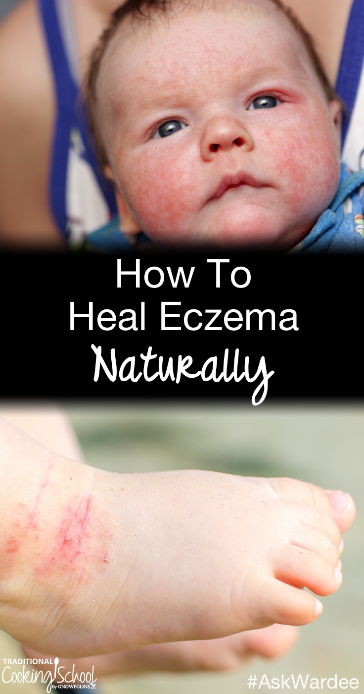 Linda K. asks, 'How can we heal my grandson's terrible eczema?' Watch, listen, or read to find out our family's story and how to heal eczema naturally. | AskWardee.tv