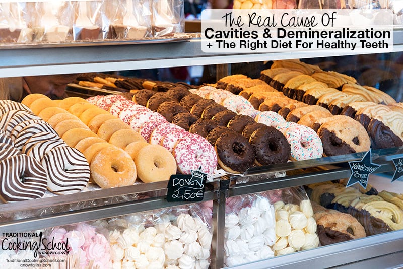 The Real Cause Of Cavities & Demineralization + The Right Diet For Healthy Teeth | Despite the myths, sugar and bacteria aren't the real culprits that cause tooth decay. Learn the REAL cause of cavities and demineralization, the foods you should avoid if you've experienced tooth decay (hint: over 85% of Americans have tooth decay!), plus the RIGHT diet for healthy teeth. | TraditionalCookingSchool.com