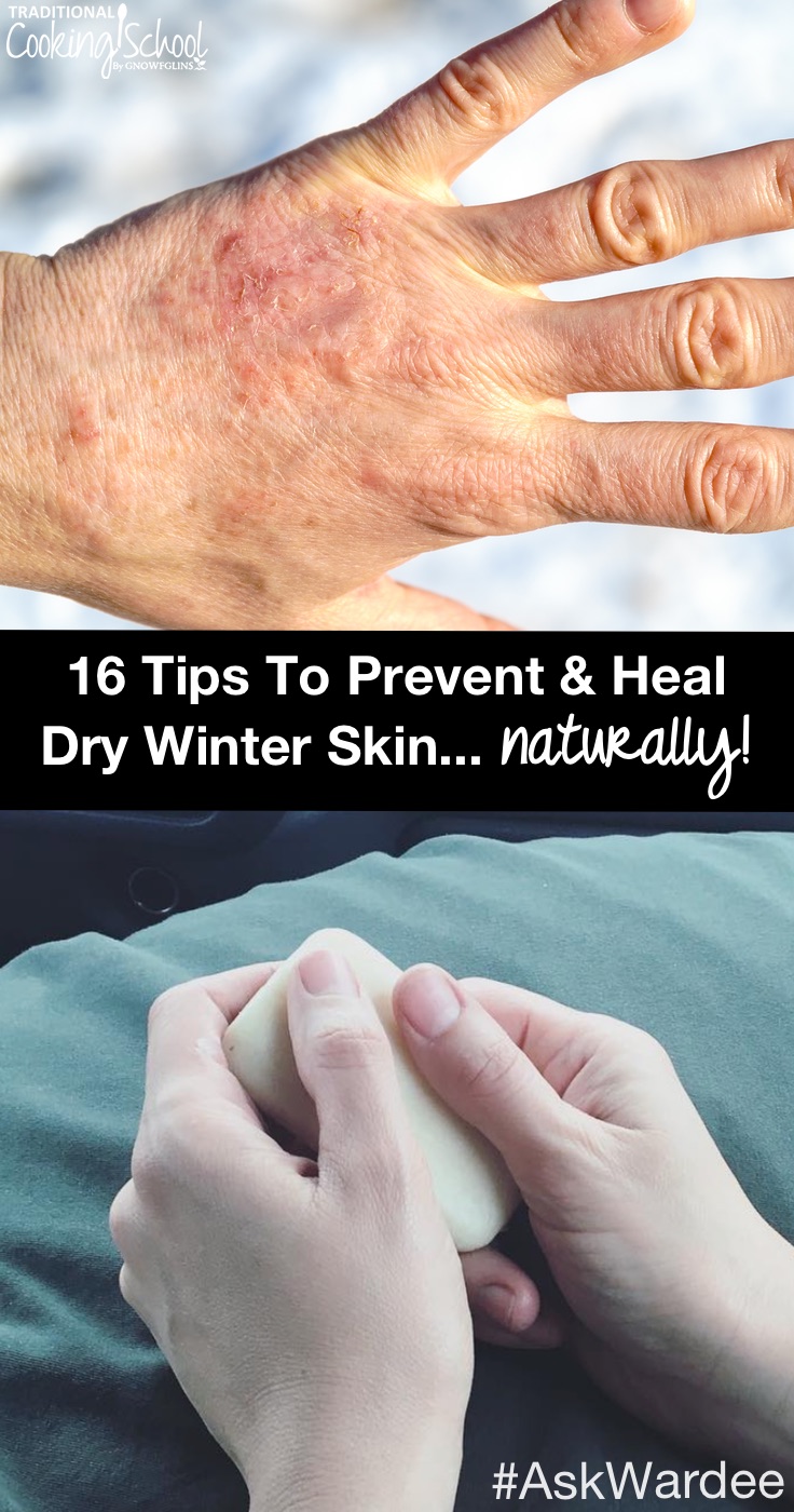 Does dry winter skin keep you scratching or in pain? Do you feel like you can't get enough lotion to heal your dry, cracking, or bleeding skin? Watch, listen, or read for my 16 tips to prevent and heal dry winter skin naturally, plus learn the BEST things to put on your skin to keep it moisturized (hint: it's NOT lotion!).