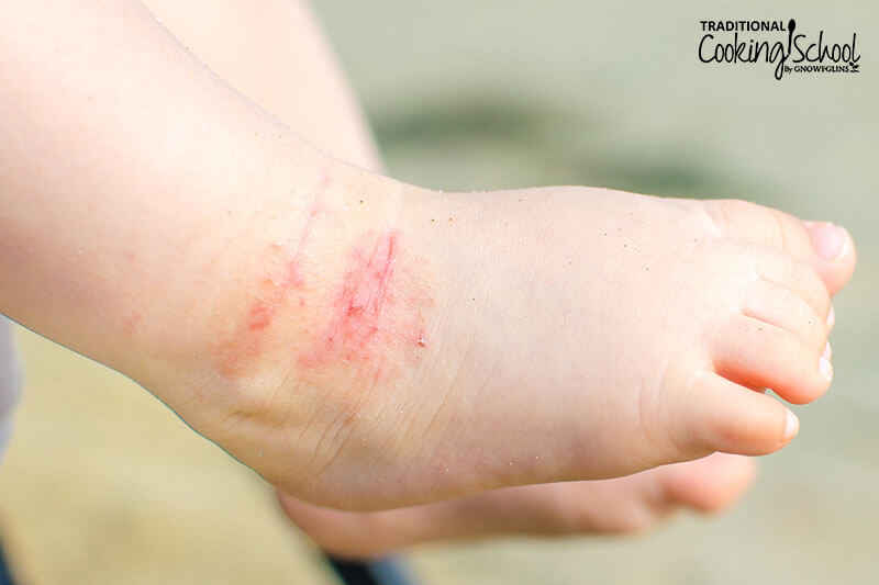 baby's feet with itchy eczema on the ankle