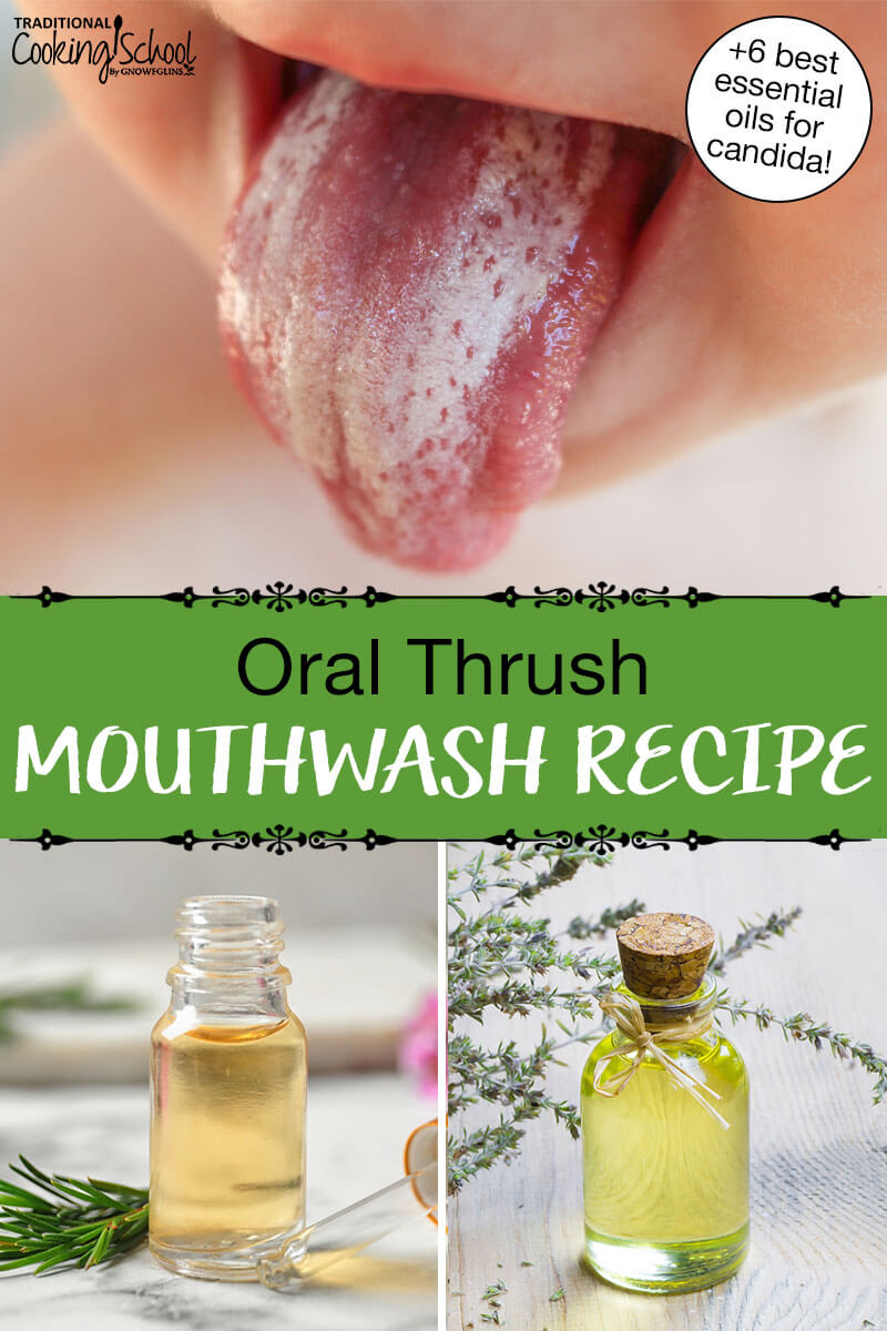 Photo collage of a child's tongue covered in white, and various small bottles of essential oils. Text overlay says: "Oral Thrush Mouthwash Recipe (+ 6 best essential oils for candida!)"