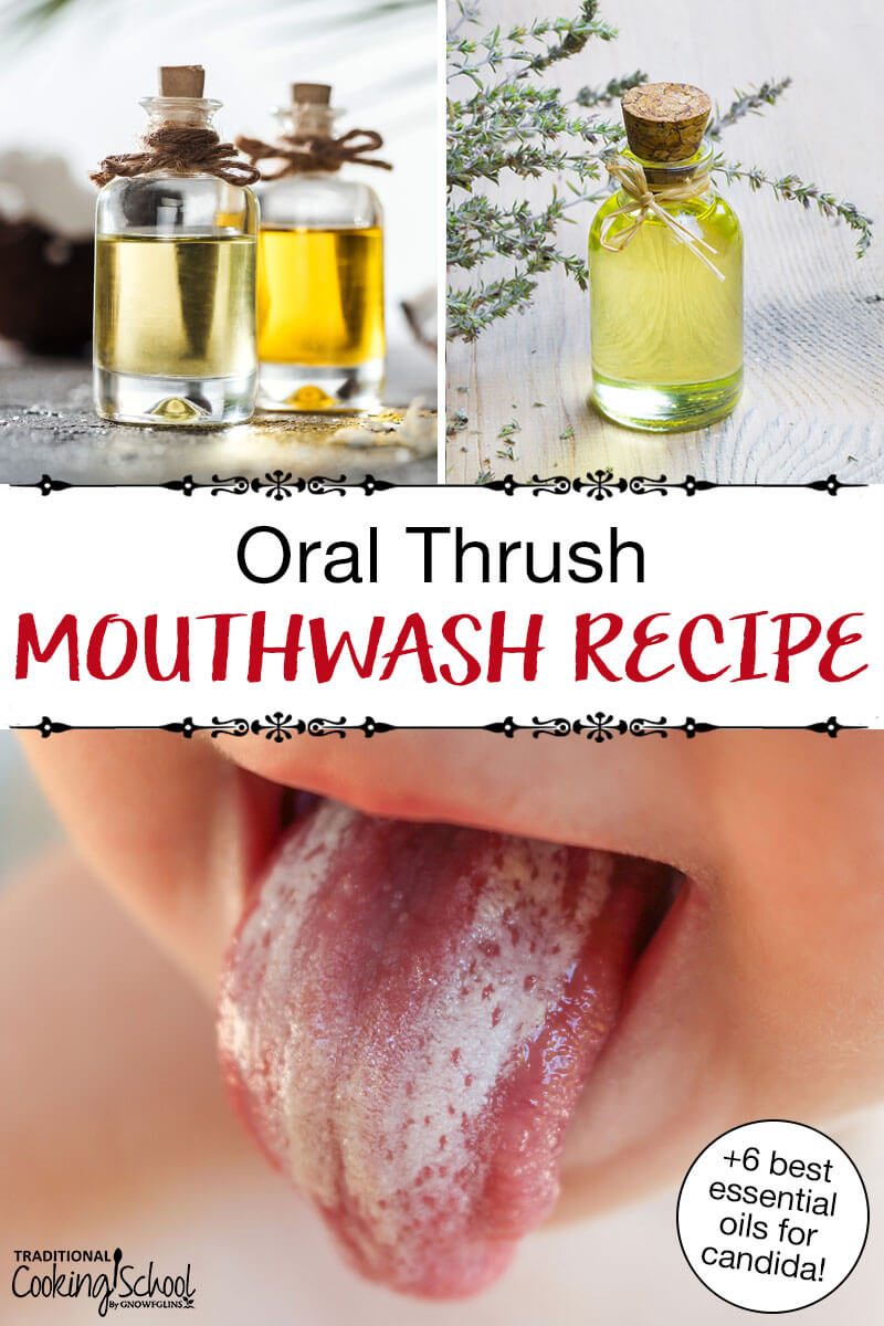 Photo collage of a child's tongue covered in white, and various small bottles of essential oils. Text overlay says: "Oral Thrush Mouthwash Recipe (+ 6 best essential oils for candida!)"