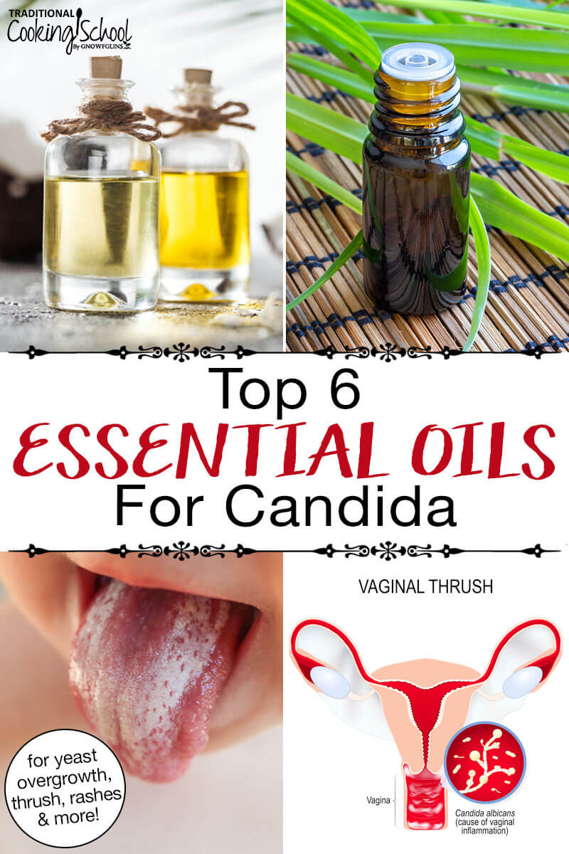 Photo collage of bottles of essential oils, a child's tongue covered in a layer of white, and an anatomical rendering of vaginal thrush. Text overlay says: "Top 6 Essential Oils For Candida (for yeast overgrowth, thrush, rashes & more!)"
