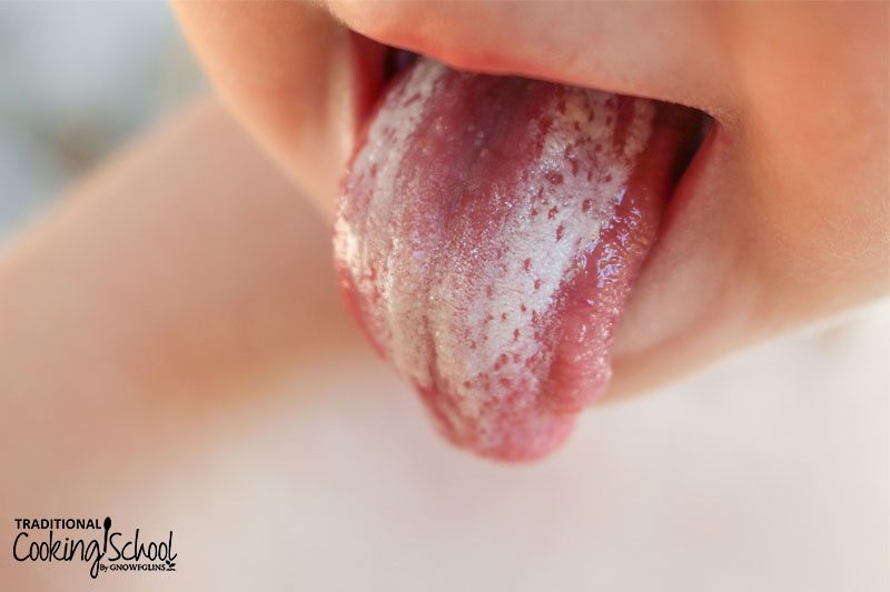 Small child's tongue covered in a layer of yeast overgrowth.